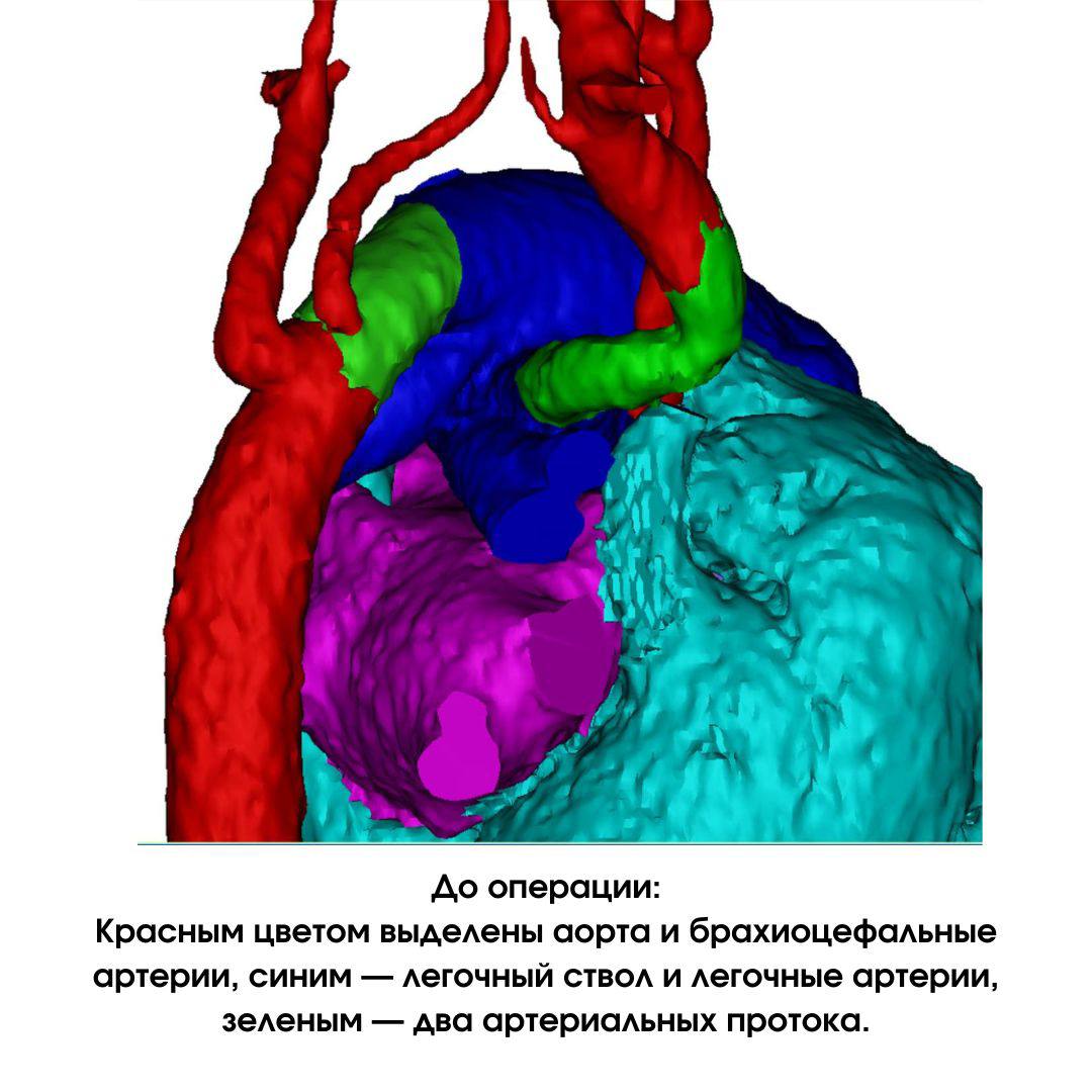 Новосибирские кардиохирурги прооперировали новорожденного с несовместимыми с жизнью пороками сердца