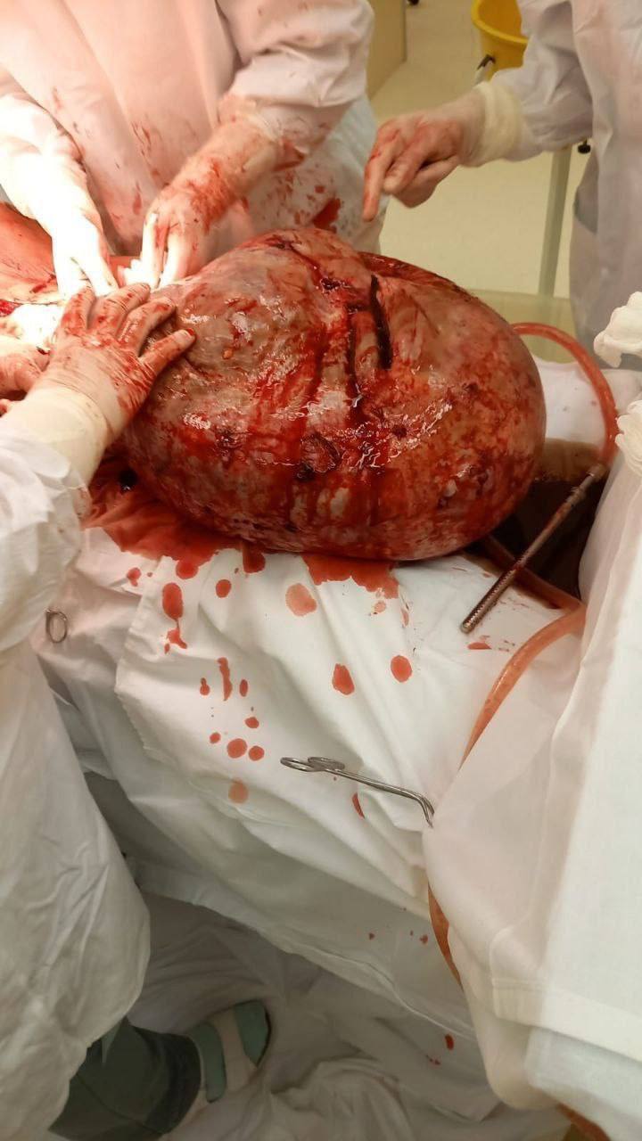 Диаметр 45 см, объем 40 литров: новгородские онкогинекологи удалили пациентке гигантскую опухоль яичника 2