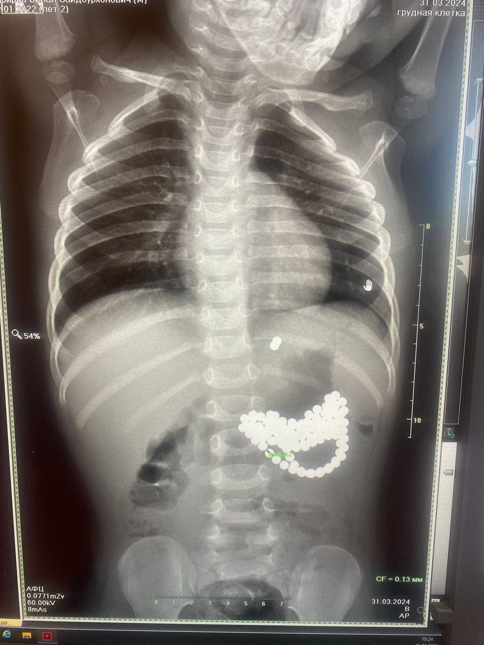 Врачи ДОКБ извлекли из желудка и кишечника двухлетнего ребёнка 124 магнитных шарика