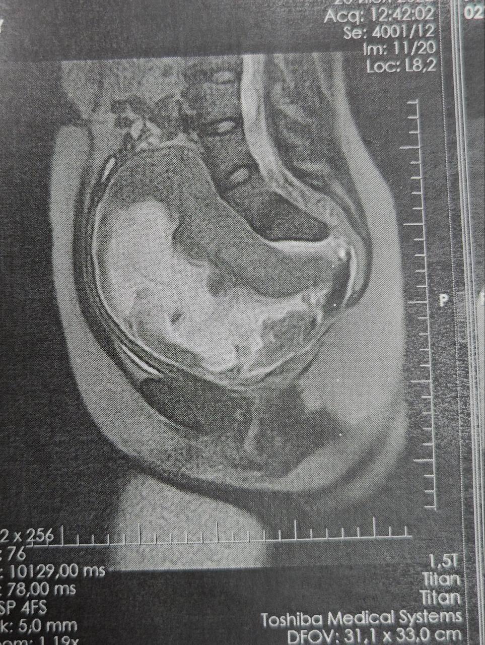 «Матка была плотно подтянута грыжей к сердцу», — московские врачи помогли родить пациентке с удвоением матки и гигантской грыжей спинномозгового канала 2