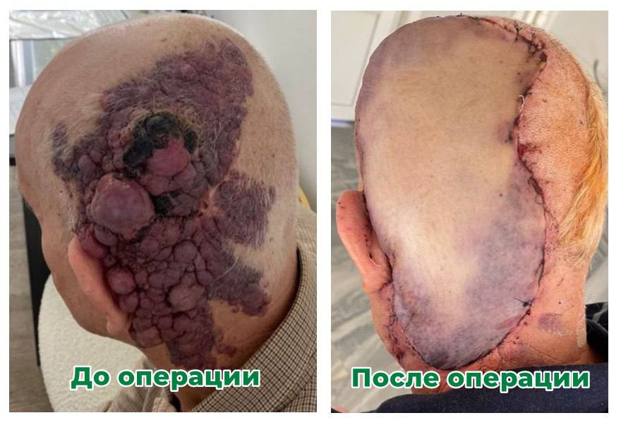 Ставропольские нейрохирурги удалили гигантскую ангиому головы, которая появилась у пациента 30 лет назад