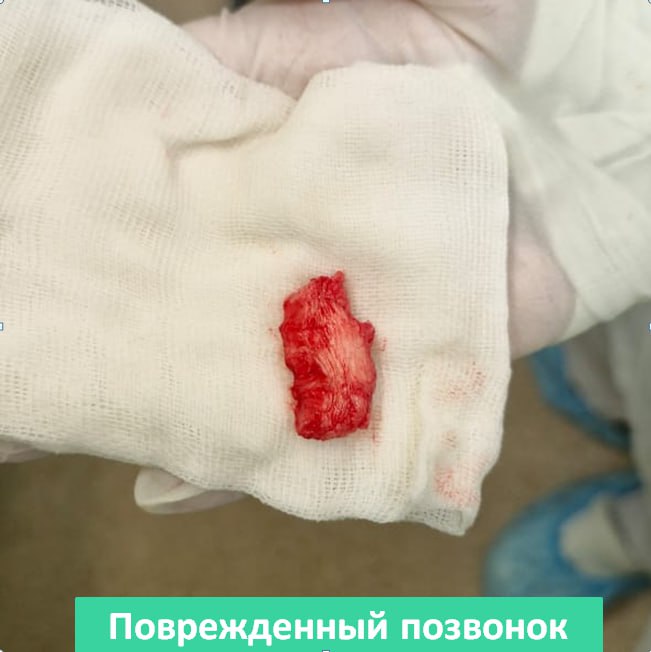 Московские нейрохирурги удалили пациенту разрушенный онкопроцессом шейный позвонок  3