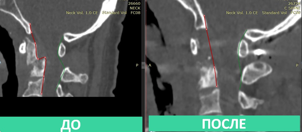 Московские нейрохирурги удалили пациенту разрушенный онкопроцессом шейный позвонок