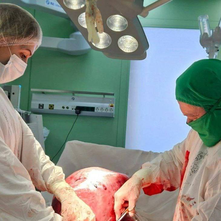 Подмосковные хирурги экстренно удалили огромную 17-килограммовую опухоль матки у пациентки, которая не обращалась к врачам несколько лет