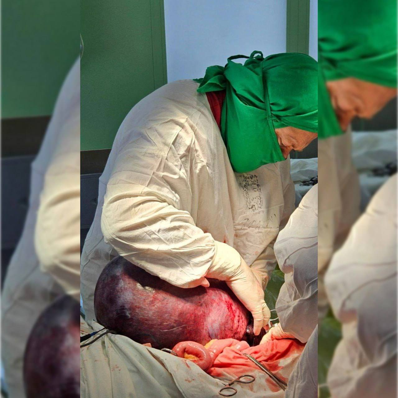 Подмосковные хирурги экстренно удалили огромную 17-килограммовую опухоль матки у пациентки, которая не обращалась к врачам несколько лет