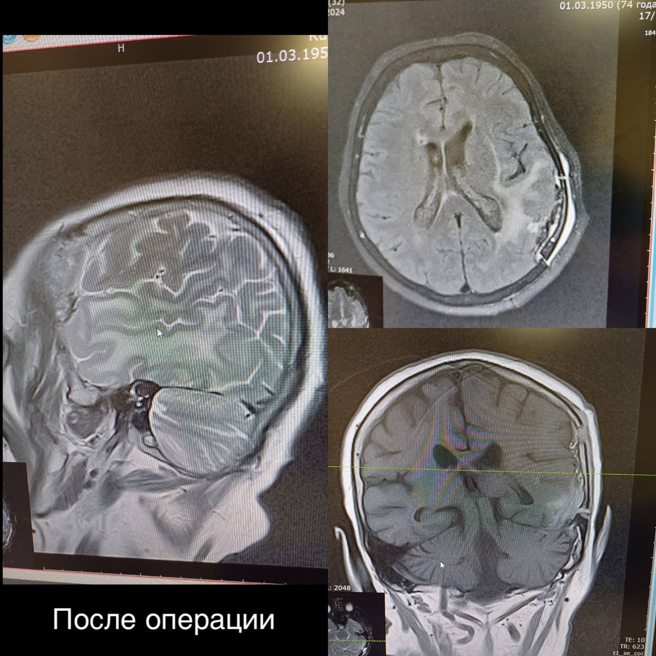 Мелитопольские нейрохирурги прооперировали пациентку с опухолью головного мозга, спаянной с крупным сосудом 2