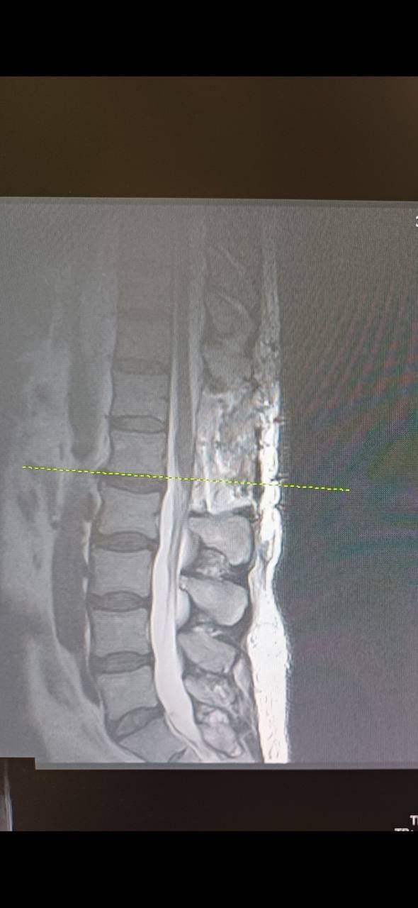 Нейрохирурги из Мелитополя удалили опухоль спинного мозга 62-летнему боксеру 2