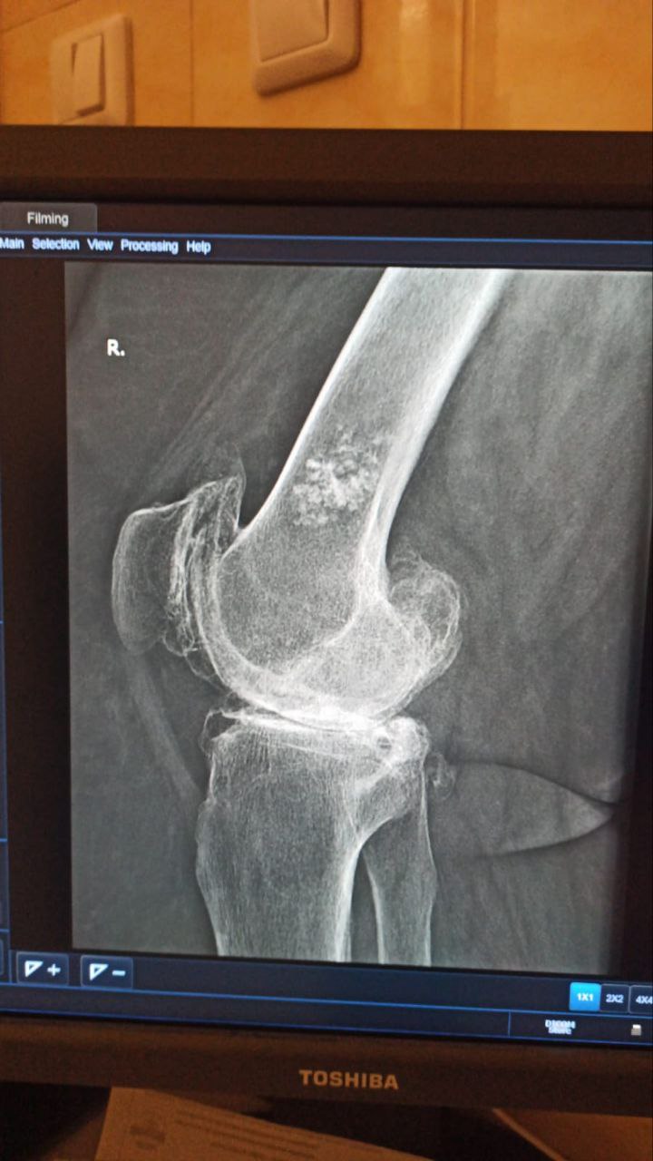 Хирурги РостГМУ вернули способность ходить пациентке с серьезной деформацией колена