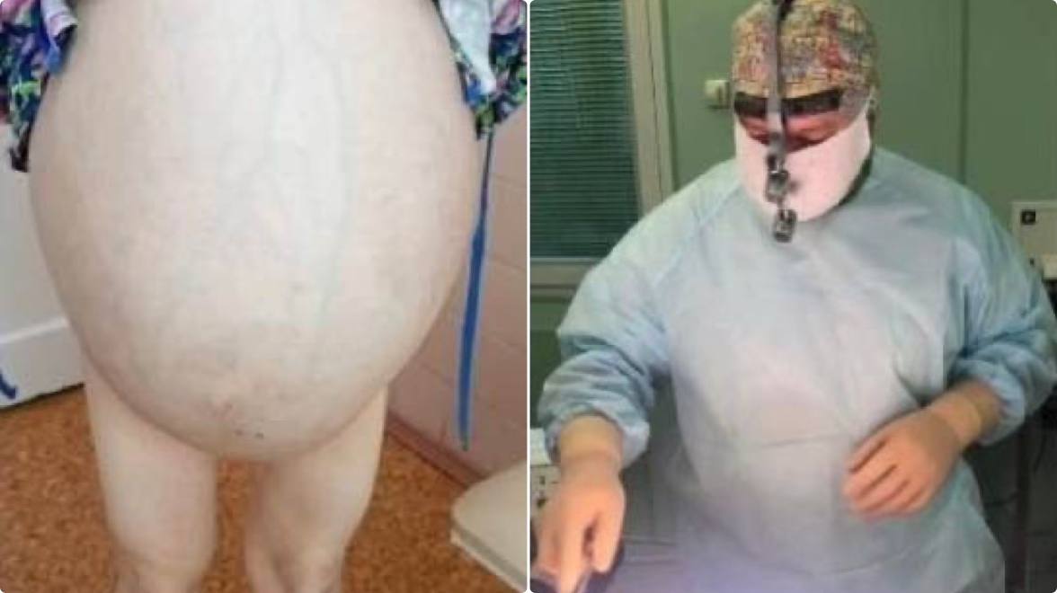 Курганские хирурги удалили пациентке опухоль, весом 50% от её массы