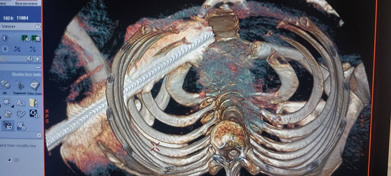 Саратовские хирурги прооперировали пациента, грудную клетку которого насквозь проткнула арматура