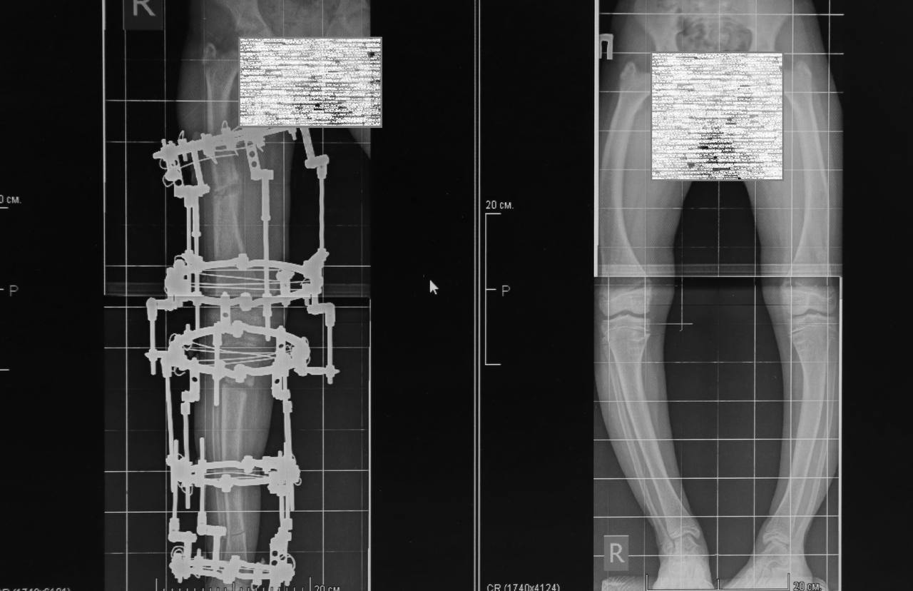В ФГБУ «НМИЦ ТО имени академика Г.А. Илизарова» Минздрава России из Москвы приехали мать с двумя дочками с деформацией ног. Патология развилась на фоне гипофосфатемического рахита, который передаётся по наследству. В детстве мать уже оперировалась в центре Илизарова, ей исправляли деформации бедра и голени с помощью аппарата Илизарова и метода чрескостного остеосинтеза. Такой же диагноз поставили и дочерям.