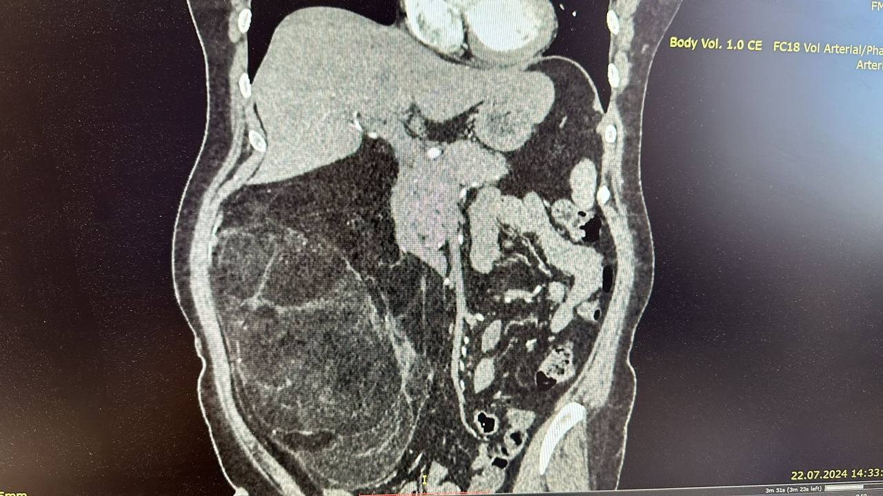 Московские хирурги удалили пациентке гигантскую липосаркому забрюшинного пространства 3