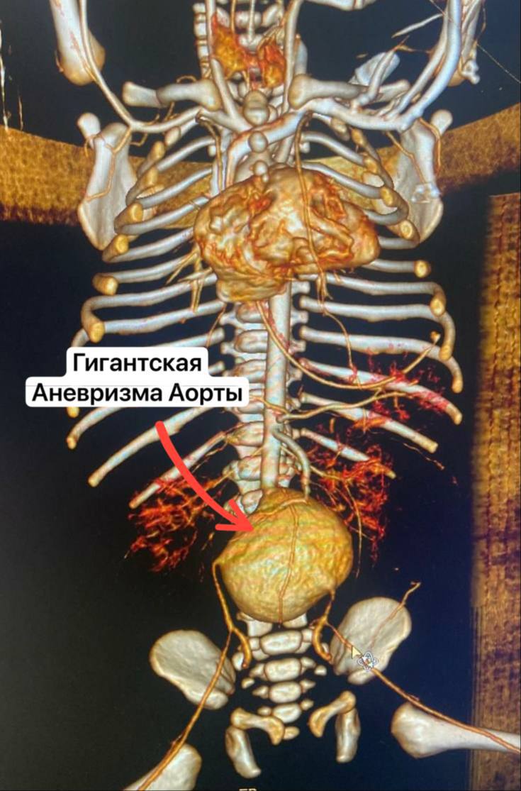 Петербургские хирурги прооперировали новорожденную с гигантской аневризмой аорты 2