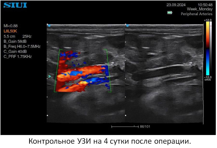 Петербургские хирурги прооперировали новорожденную с гигантской аневризмой аорты 6