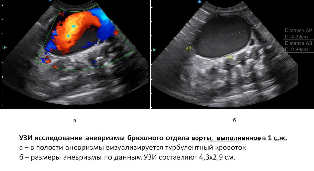 Петербургские хирурги прооперировали новорожденную с гигантской аневризмой аорты 5