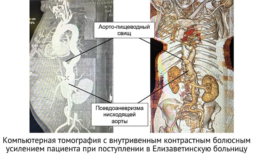 Петербургские врачи провели редкую для скоропомощного стационара операцию пациенту с аорто-пищеводным свищом 2
