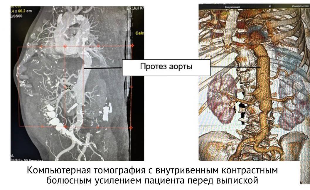 Петербургские врачи провели редкую для скоропомощного стационара операцию пациенту с аорто-пищеводным свищом