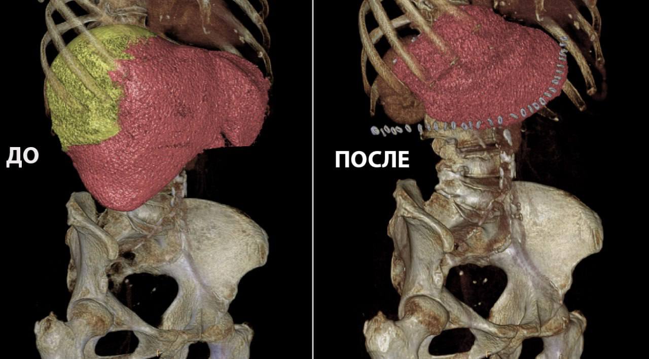 Новосибирские врачи провели сложную операцию по поводу рака, который рецидивировал спустя 35 лет