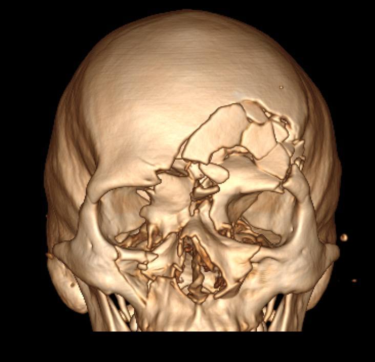 Краснодарские врачи восстановили лицо сварщику после тяжелой производственной травмы