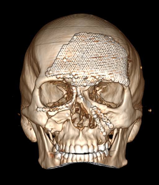 Краснодарские врачи восстановили лицо сварщику после тяжелой производственной травмы 2