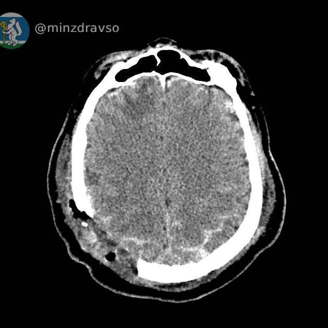 Свердловские врачи прооперировали пациента, на голову которого упала стрела строительного крана 2