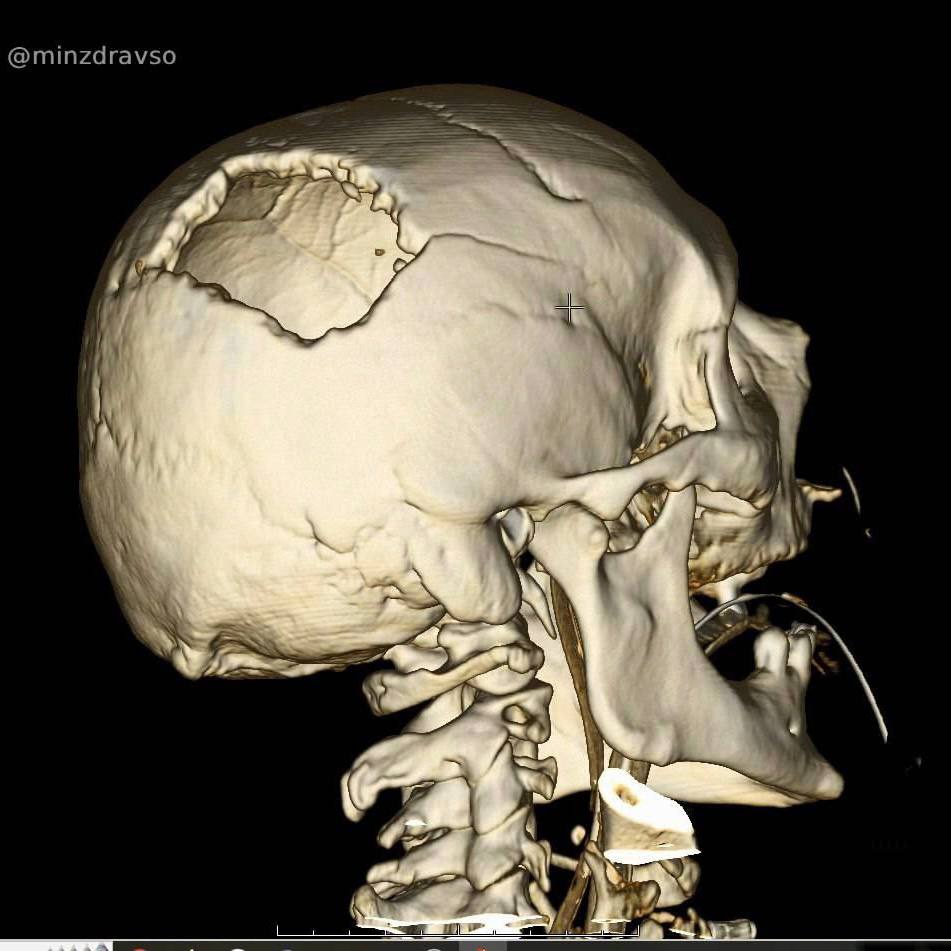 Свердловские врачи прооперировали пациента, на голову которого упала стрела строительного крана