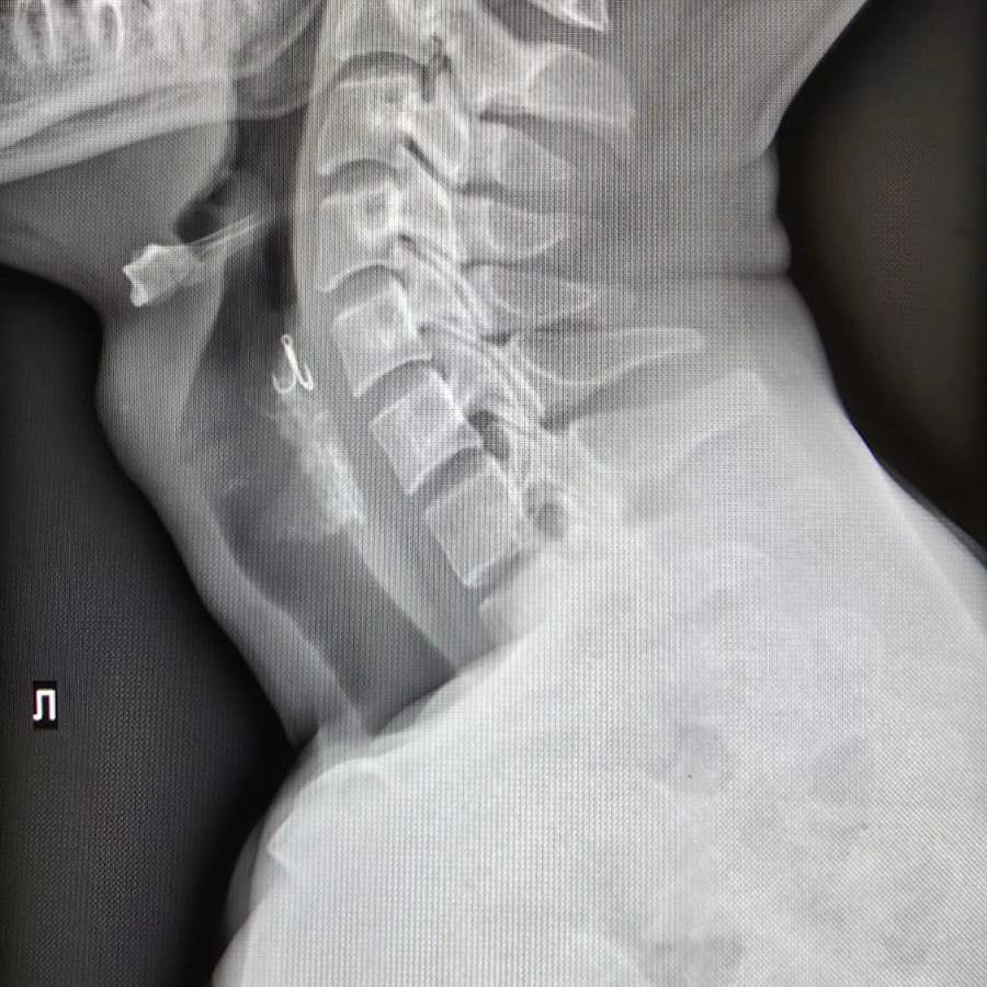 Красноярские врачи вытащили рыболовный крючок, который случайно проглотил пациент 2