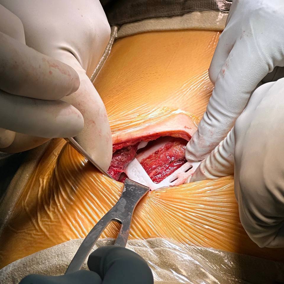 В ФГБУ «Национальный медицинский исследовательский центр фтизиопульмонологии и инфекционных заболеваний» Минздрава России обратилась женщина с жалобами на выпячивание в области грудной клетки при дыхании и кашле. Подробности узнала «Медицинская Россия». Симптомы появились спустя несколько лет после удаления 4-го ребра слева из-за доброкачественной опухоли. Со временем жалобы усиливались и начали приносить ей дискомфорт.