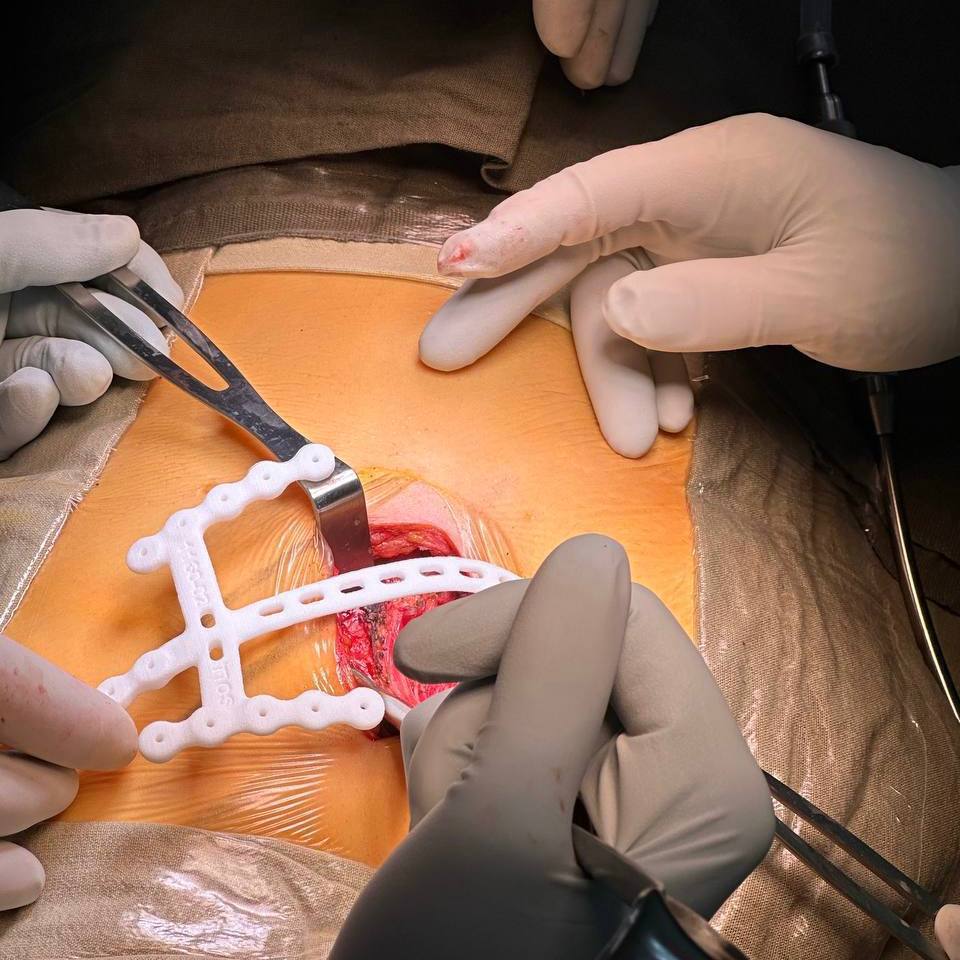 Хирурги установили «новые» рёбра пациентке, у которой при дыхании легкое выходило за пределы грудной клетки