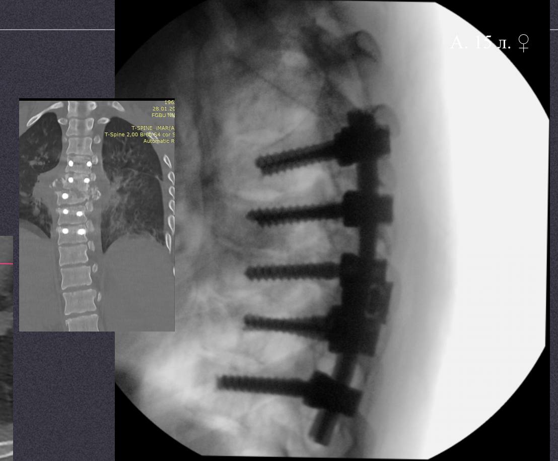 Новосибирские врачи спасли жизнь 15-летней пациентки, упавшей с 10 этажа 2