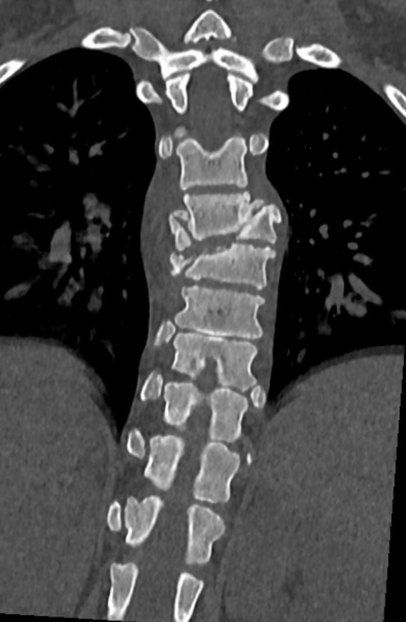 В ФГБУ «Новосибирский НИИТО им. Я. Л. Цивьяна» доставили пациентку с тяжелейшими повреждениями после падения с десятого этажа. У девочки диагностировали сочетанную кататравму: ушибы сердца и легких, множественные переломы ребер, а также тяжелейшую позвоночно-спинномозговую травму с повреждением спинного мозга. Трагедия произошла 11 мая, когда она убиралась в комнате, у неё закружилась голова и она выпала из окна. Сначала пациентку госпитализировали в ГБУЗ НСО «ГНОКБ», где врачи провели жизнеспасающие мероприятия в отделении реанимации. Состояние девочки было крайне тяжелым: потребовалась трахеостомия и длительная искусственная вентиляция легких, развились инфекционные осложнения в виде пневмонии.