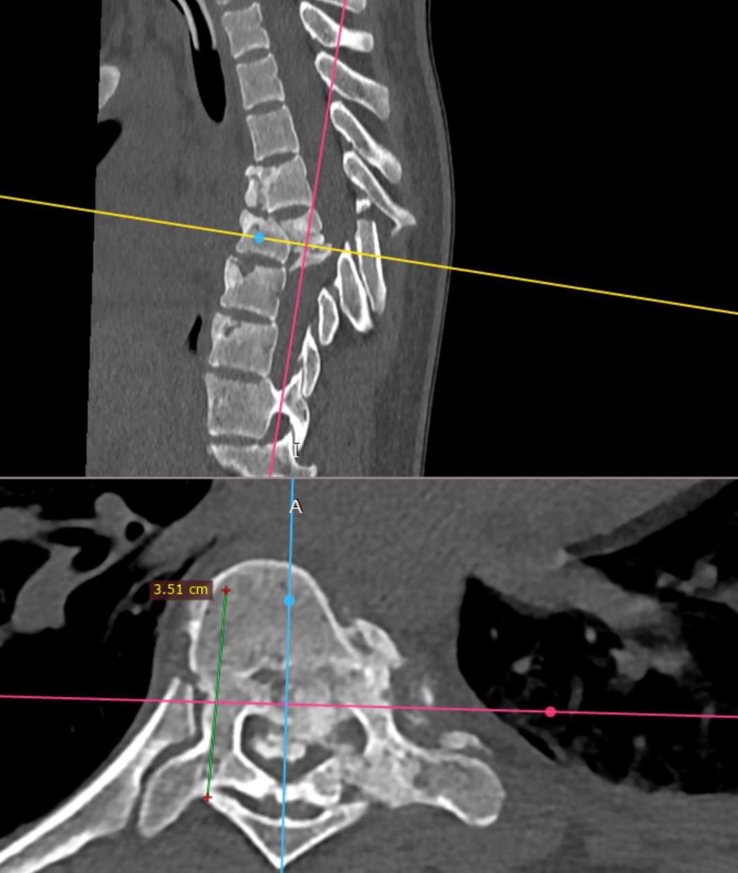 В ФГБУ «Новосибирский НИИТО им. Я. Л. Цивьяна» доставили пациентку с тяжелейшими повреждениями после падения с десятого этажа. У девочки диагностировали сочетанную кататравму: ушибы сердца и легких, множественные переломы ребер, а также тяжелейшую позвоночно-спинномозговую травму с повреждением спинного мозга. Трагедия произошла 11 мая, когда она убиралась в комнате, у неё закружилась голова и она выпала из окна. Сначала пациентку госпитализировали в ГБУЗ НСО «ГНОКБ», где врачи провели жизнеспасающие мероприятия в отделении реанимации. Состояние девочки было крайне тяжелым: потребовалась трахеостомия и длительная искусственная вентиляция легких, развились инфекционные осложнения в виде пневмонии.
