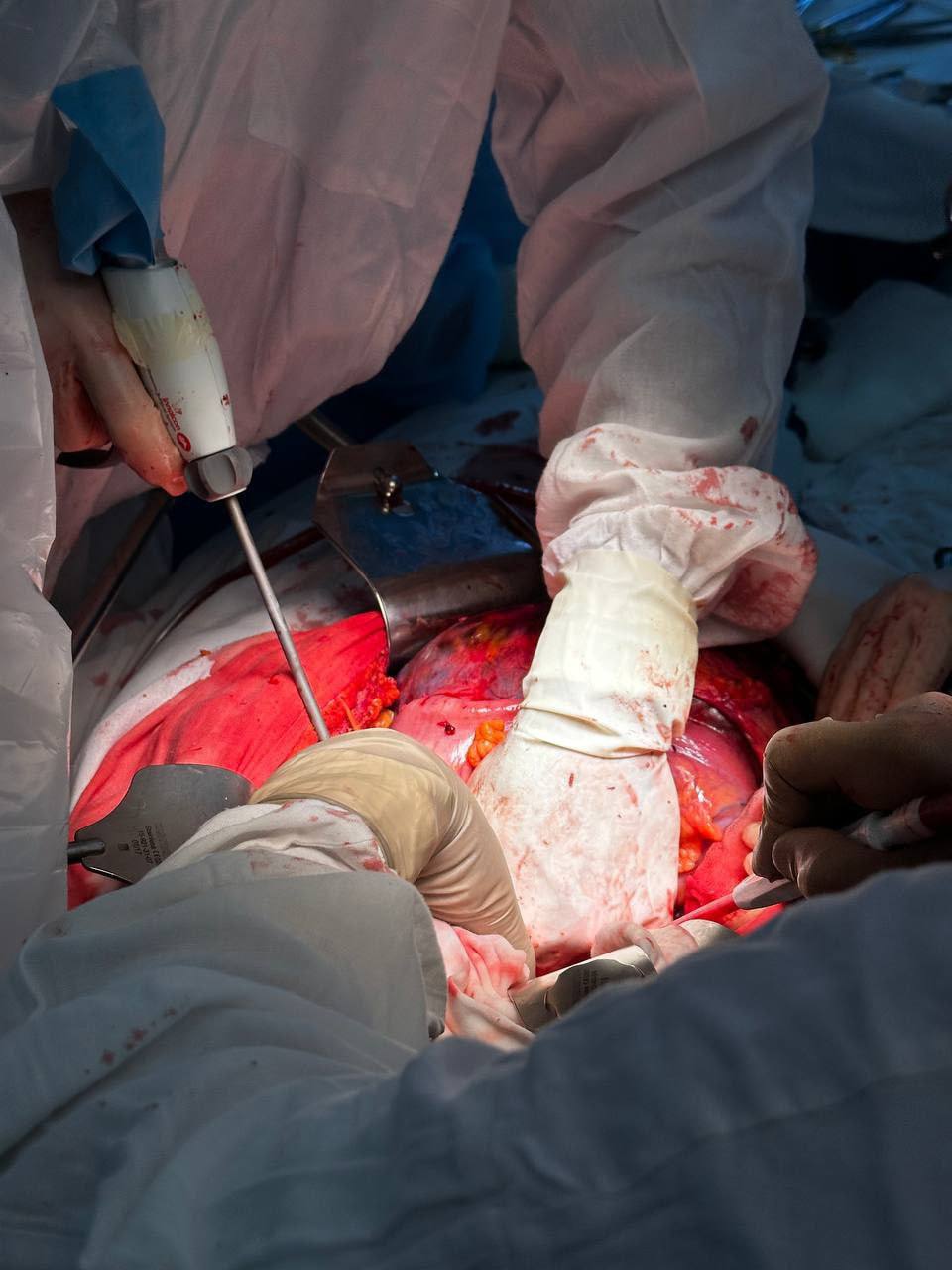 В Сибирском научно-клиническом центре ФМБА прооперировали пациента со злокачественной опухолью малого таза весом 5 кг