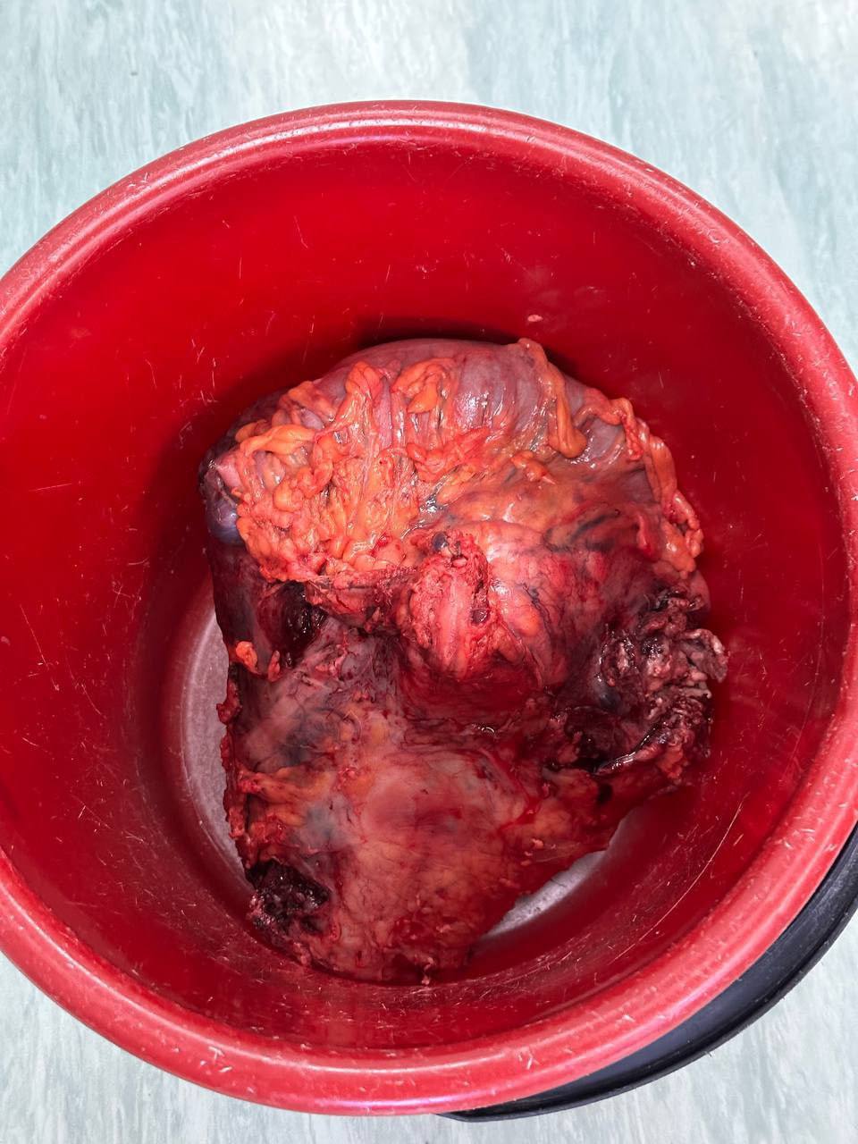 31-летний пациент поступил в центр в тяжелом состоянии. Перед операцией ему провели интенсивную терапию для купирования болевого синдрома, септического состояния и нормализации работы почек. Опухоль занимала всю полость малого таза, сдавливала нижнюю полую вену и мочеточники. «Было септическое состояние, то есть весь организм находился в состоянии воспаления. Опухоль была с распадом, поэтому постоянно кровоточила: из-за этого у пациента была анемия тяжёлой степени, которая требовала переливания компонентов крови. Несмотря на тяжелое состояние, мы приняли решение оперировать — так как только удаление гигантской опухоли позволило бы улучшить состояние молодого человека, и дало бы возможность проводить дополнительное противоопухолевое лечение», — рассказал «Медицинской России» Руслан Хлобыстин, врач-онколог-хирург ФСНКЦ ФМБА России.