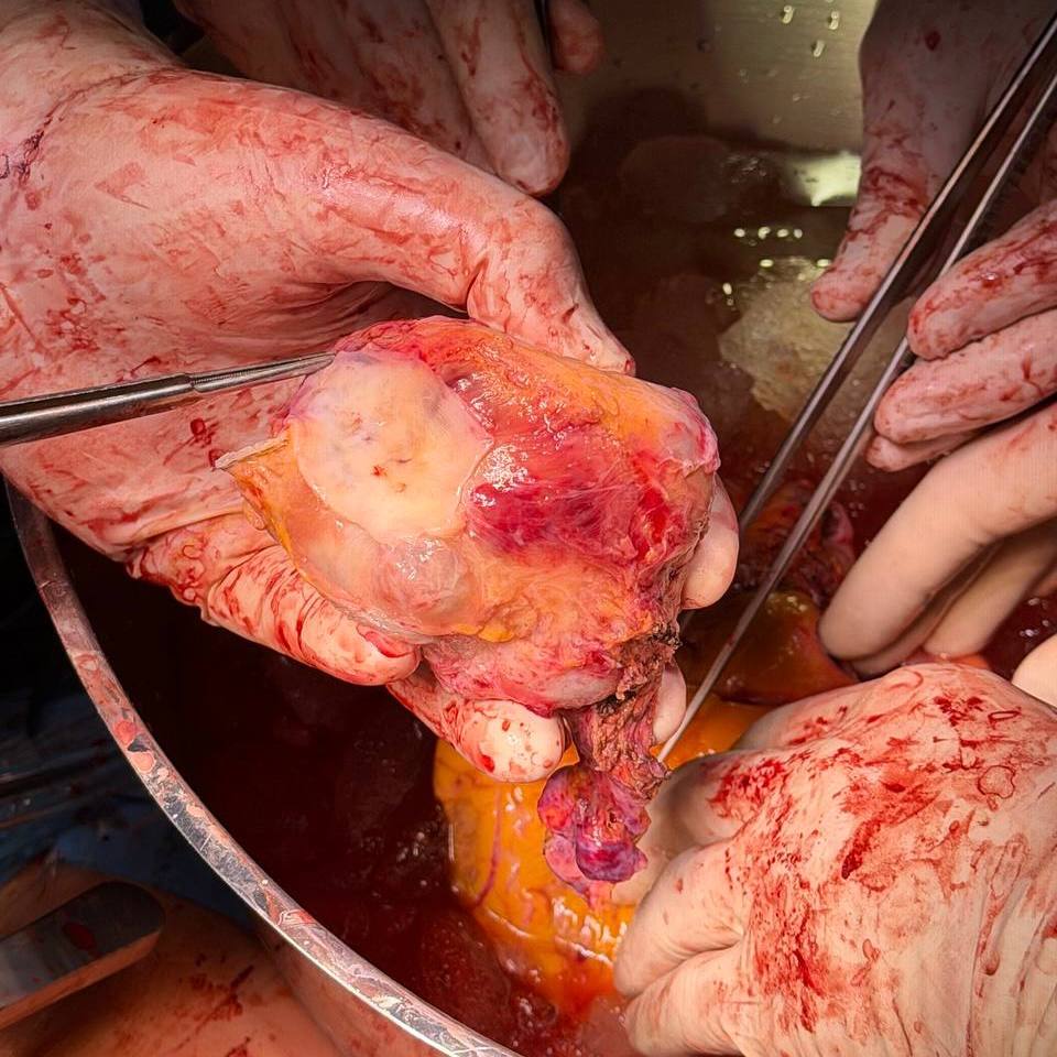 В ФГБУ «НМИЦ Онкологии им. Н.Н. Блохина» Минздрава России поступила пациентка с параганглиомой сердца. Новообразование исходило из задней стенки левого предсердия, и было спаяно с магистральными сосудами, пищеводом, бронхами и лёгочными артериями. «Сложность клинического случая заключалась прежде всего в том, что параганглиома сердца — это крайне редкая патология. В связи с этим не существует чётко выработанной и универсальной тактики лечения», — прокомментировал «Медицинской России» заведующий отделением сердечно-сосудистой хирургии центра, оперирующий хирург Сергей Стефанов.