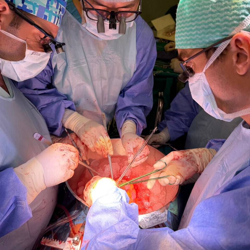 В ФГБУ «НМИЦ Онкологии им. Н.Н. Блохина» Минздрава России поступила пациентка с параганглиомой сердца. Новообразование исходило из задней стенки левого предсердия, и было спаяно с магистральными сосудами, пищеводом, бронхами и лёгочными артериями. «Сложность клинического случая заключалась прежде всего в том, что параганглиома сердца — это крайне редкая патология. В связи с этим не существует чётко выработанной и универсальной тактики лечения», — прокомментировал «Медицинской России» заведующий отделением сердечно-сосудистой хирургии центра, оперирующий хирург Сергей Стефанов.