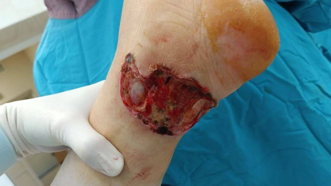 В Тюмени пациентка ОКБ № 2 в декабре 2025 года проходила лечение в травматологическом отделении. После операции по удалению металлоконструкции она находилась в одноместной палате. Пациентка рассказала, что ничего не чувствовала после эпидуральной анестезии, поэтому не заметила, что её нога была прижата к горячей батарее, и «никто ей об этом не сказал», она получила ожог. На следующий день почувствовала сильную боль, ей сделали три укола обезболивающих и якобы сказали, что дальше всё само пройдёт.