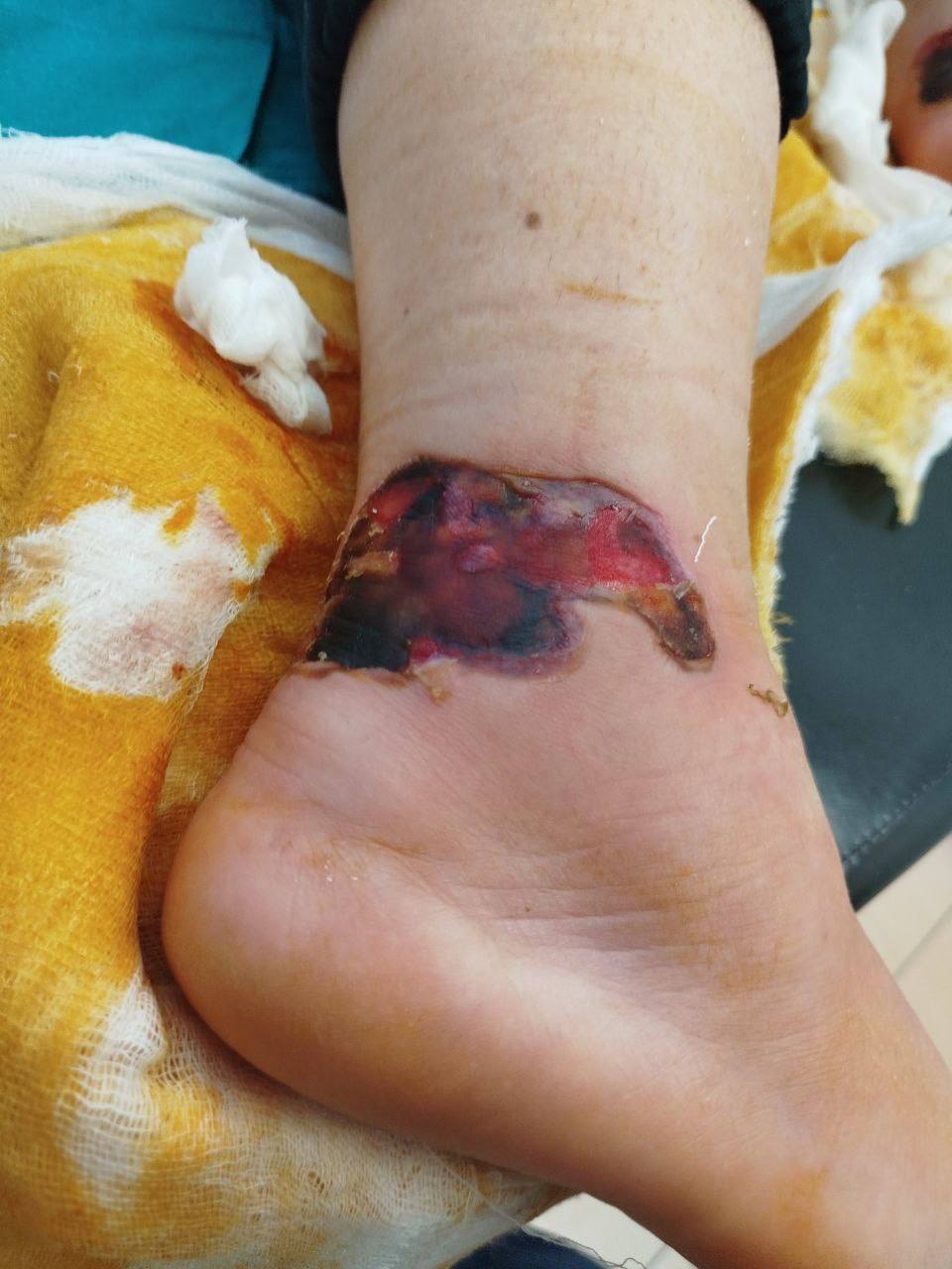 В Тюмени пациентка ОКБ № 2 в декабре 2025 года проходила лечение в травматологическом отделении. После операции по удалению металлоконструкции она находилась в одноместной палате. Пациентка рассказала, что ничего не чувствовала после эпидуральной анестезии, поэтому не заметила, что её нога была прижата к горячей батарее, и «никто ей об этом не сказал», она получила ожог. На следующий день почувствовала сильную боль, ей сделали три укола обезболивающих и якобы сказали, что дальше всё само пройдёт.