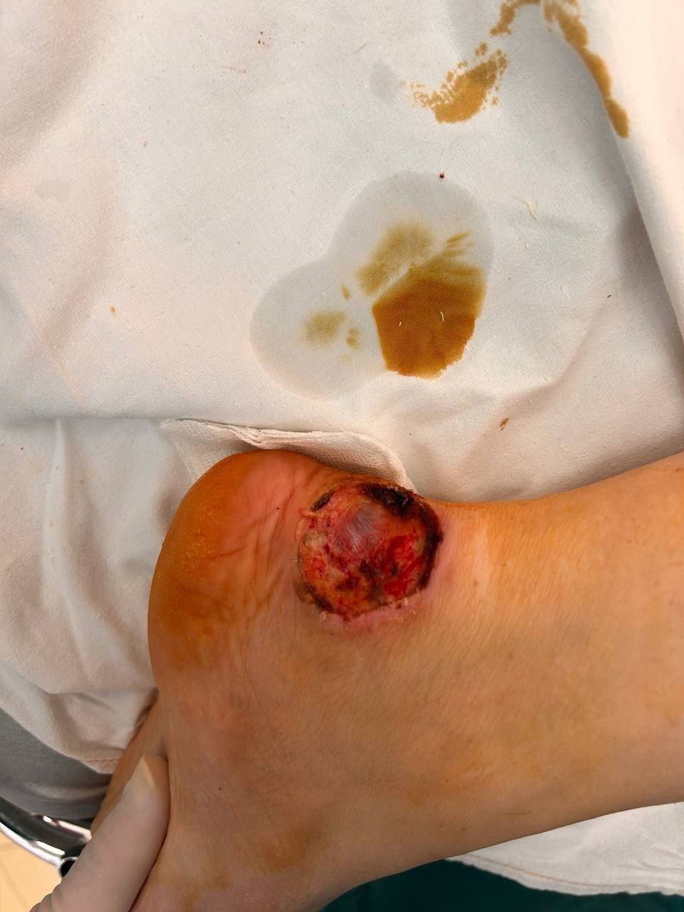 В Тюмени пациентка ОКБ № 2 в декабре 2025 года проходила лечение в травматологическом отделении. После операции по удалению металлоконструкции она находилась в одноместной палате. Пациентка рассказала, что ничего не чувствовала после эпидуральной анестезии, поэтому не заметила, что её нога была прижата к горячей батарее, и «никто ей об этом не сказал», она получила ожог. На следующий день почувствовала сильную боль, ей сделали три укола обезболивающих и якобы сказали, что дальше всё само пройдёт.