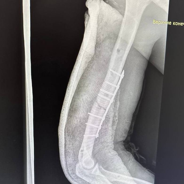 В ГБУЗ НО «Нижегородская областная клиническая больница им. Н.А. Семашко» бригада скорой медицинской помощи доставила строителя, выжившего после падения с высоты. Мужчина упал с 32 этажа строящегося высотного дома. Приземлился он только на 12 этаже, получив политравму, которую врачи охарактеризовали как «один большой перелом».