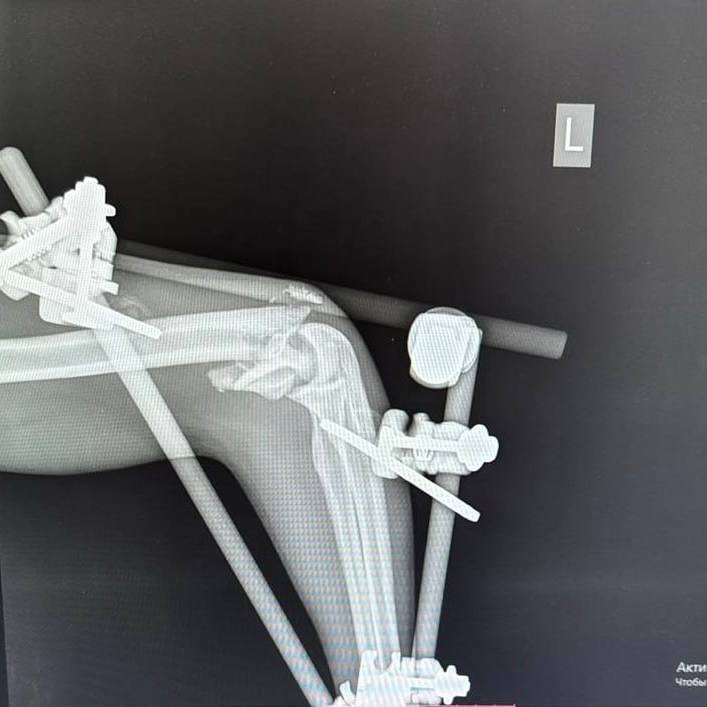 В ГБУЗ НО «Нижегородская областная клиническая больница им. Н.А. Семашко» бригада скорой медицинской помощи доставила строителя, выжившего после падения с высоты. Мужчина упал с 32 этажа строящегося высотного дома. Приземлился он только на 12 этаже, получив политравму, которую врачи охарактеризовали как «один большой перелом».