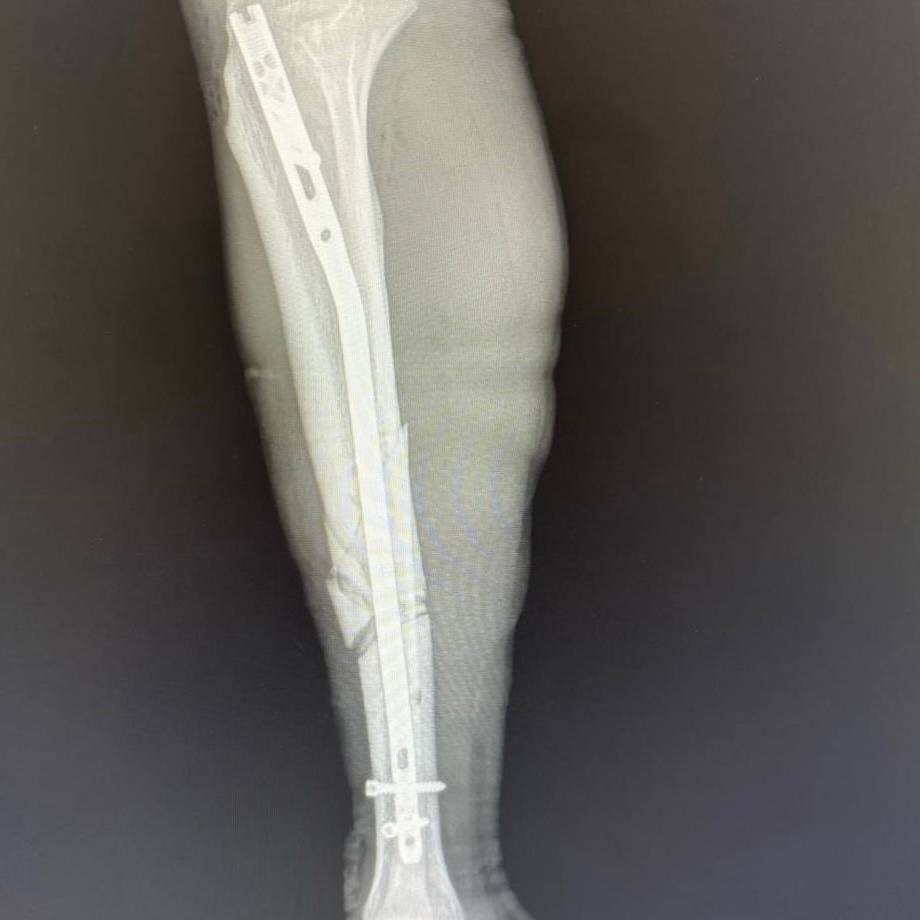 В ГБУЗ НО «Нижегородская областная клиническая больница им. Н.А. Семашко» бригада скорой медицинской помощи доставила строителя, выжившего после падения с высоты. Мужчина упал с 32 этажа строящегося высотного дома. Приземлился он только на 12 этаже, получив политравму, которую врачи охарактеризовали как «один большой перелом».