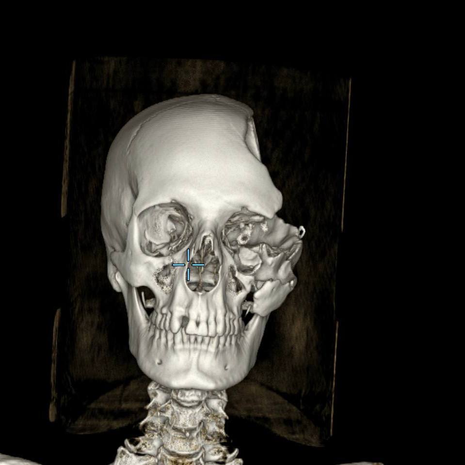 В ГБУЗ «НИИ скорой помощи им. И.И. Джанелидзе» поступил пациент с тяжелейшим сочетанным огнестрельным ранением в параорбитальную область. Мужчина получил обширное повреждение костей черепа и глазницы с атрофией зрительного нерва и полной утратой зрения на поражённой стороне. На предыдущих этапах лечения пациенту была выполнена декомпрессионная трепанация черепа с удалением латеральной стенки глазницы.