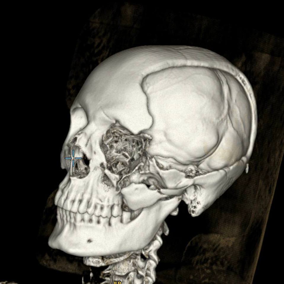 Петербургские врачи реконструировали череп пациенту с огнестрельным ранением