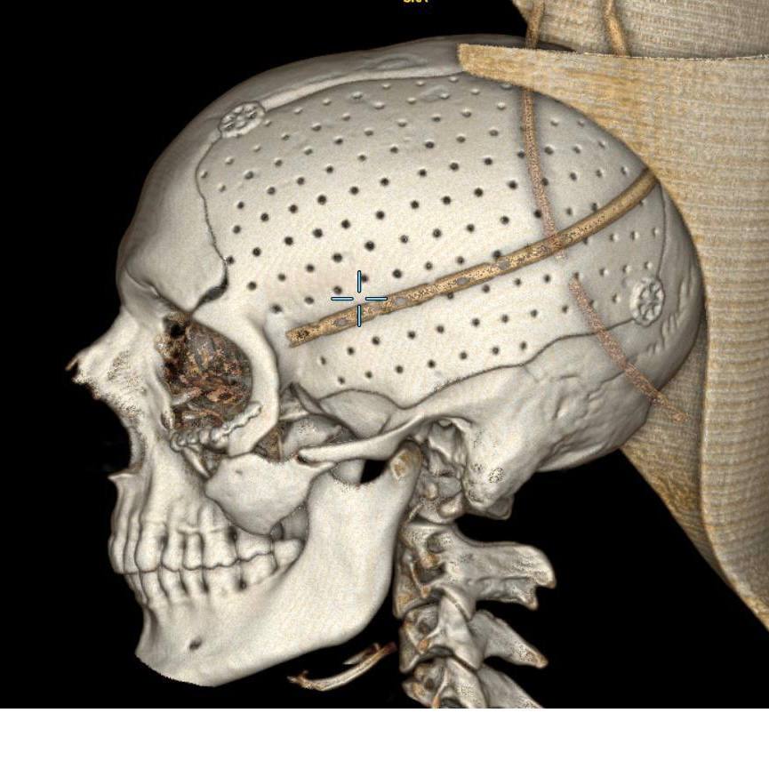 В ГБУЗ «НИИ скорой помощи им. И.И. Джанелидзе» поступил пациент с тяжелейшим сочетанным огнестрельным ранением в параорбитальную область. Мужчина получил обширное повреждение костей черепа и глазницы с атрофией зрительного нерва и полной утратой зрения на поражённой стороне. На предыдущих этапах лечения пациенту была выполнена декомпрессионная трепанация черепа с удалением латеральной стенки глазницы.