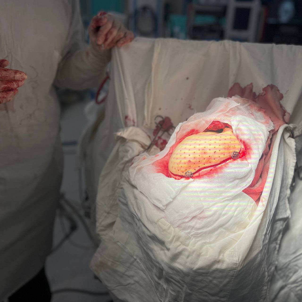 В ГБУЗ «НИИ скорой помощи им. И.И. Джанелидзе» поступил пациент с тяжелейшим сочетанным огнестрельным ранением в параорбитальную область. Мужчина получил обширное повреждение костей черепа и глазницы с атрофией зрительного нерва и полной утратой зрения на поражённой стороне. На предыдущих этапах лечения пациенту была выполнена декомпрессионная трепанация черепа с удалением латеральной стенки глазницы.