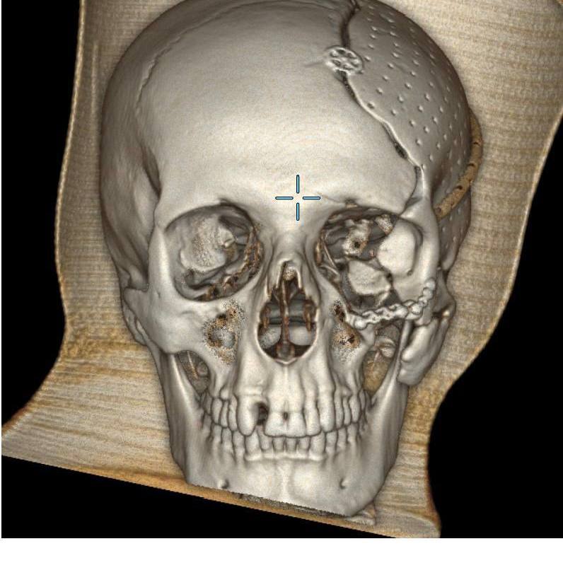 В ГБУЗ «НИИ скорой помощи им. И.И. Джанелидзе» поступил пациент с тяжелейшим сочетанным огнестрельным ранением в параорбитальную область. Мужчина получил обширное повреждение костей черепа и глазницы с атрофией зрительного нерва и полной утратой зрения на поражённой стороне. На предыдущих этапах лечения пациенту была выполнена декомпрессионная трепанация черепа с удалением латеральной стенки глазницы.