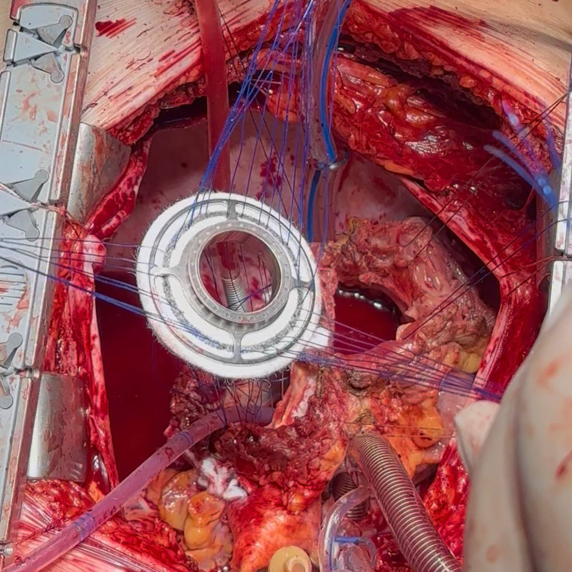 Петербургские врачи впервые в России имплантировали два искусственных желудочка сердца пациенту