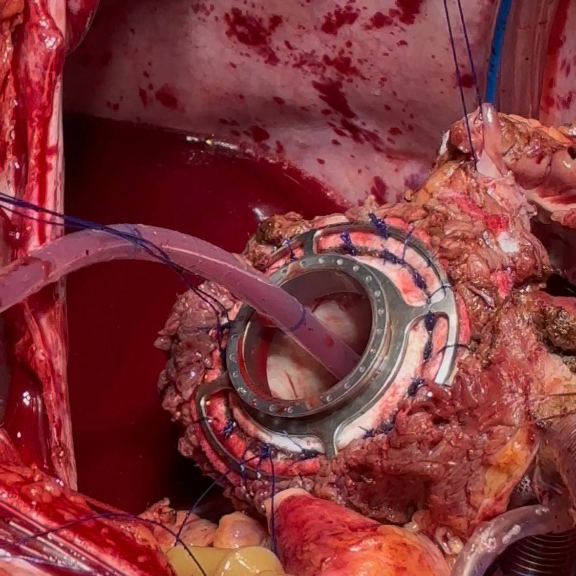 В СПб ГБУЗ «Городская Мариинская больница» поступил мужчина с терминальной стадией сердечной недостаточности. При поступлении фракция выброса его левого желудочка составляла всего 10%. У пациента ранее была диагностирована дилатационная кардиомиопатия смешанного генеза. У него также был целый комплекс опасных осложнений: рецидивирующая тромбоэмболия лёгочной артерии, хроническая тромбоэмболическая лёгочная гипертензия, инфаркт-пневмония.