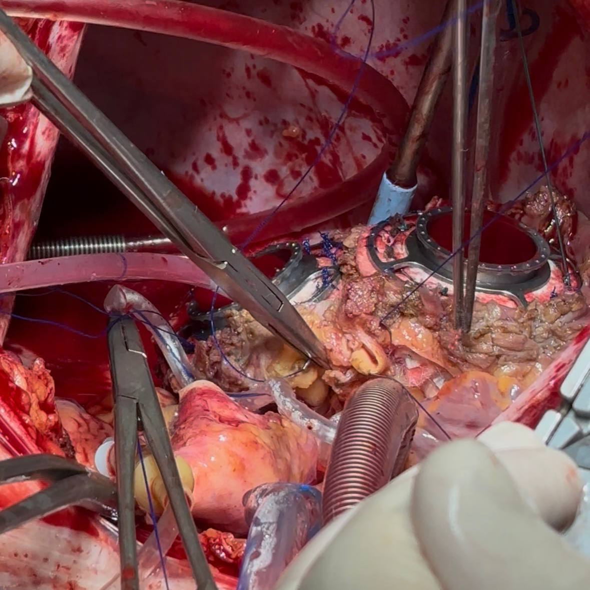 В СПб ГБУЗ «Городская Мариинская больница» поступил мужчина с терминальной стадией сердечной недостаточности. При поступлении фракция выброса его левого желудочка составляла всего 10%. У пациента ранее была диагностирована дилатационная кардиомиопатия смешанного генеза. У него также был целый комплекс опасных осложнений: рецидивирующая тромбоэмболия лёгочной артерии, хроническая тромбоэмболическая лёгочная гипертензия, инфаркт-пневмония.